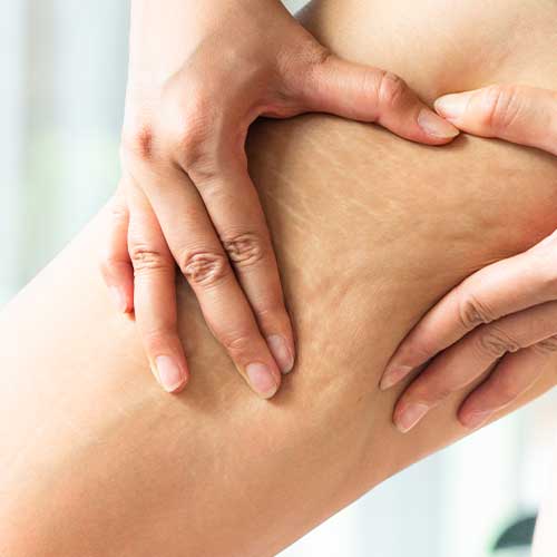 Anticellulitesmagliature